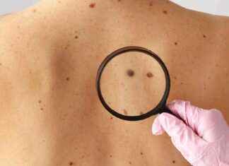 2024 Yılında En İyi Deri Onkolojisi Makalelerini Okuyun: Tırnak Bulguları, Güneş Kremi 2024-ylnda-en-iyi-deri-onkolojisi-makalelerini-okuyun-trnak-bulgular-gne-kremi