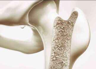 İnfekte Kemik Boşluklarını Tedavi Etmek İçin Çift Fonksiyonlu Qx-D İskeleler infekte-kemik-boluklarn-tedavi-etmek-iin-ift-fonksiyonlu-qx-d-iskeleler