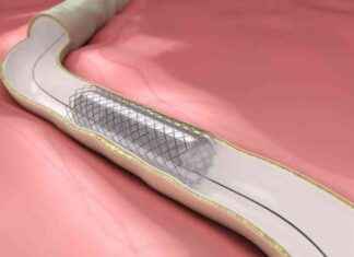 Lazer Dokuyla Şekillendirilmiş Stentler: Damar Hastalıkları İçin Umut Verici Çözüm lazer-dokuyla-ekillendirilmi-stentler-damar-hastalklar-iin-umut-verici-zm