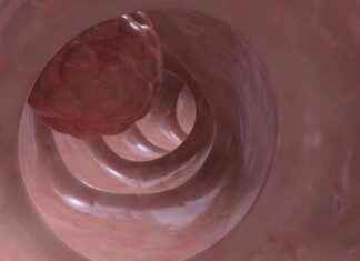 Cerrahiden sonra celecoxib ile fayda sağlayan hastaları tanımlayan ctDNA kan testi cerrahiden-sonra-celecoxib-ile-fayda-salayan-hastalar-tanmlayan-ctdna-kan-testi