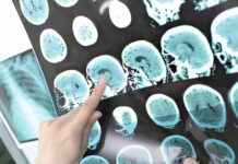 İnme Sonrası Beyin Aktivitesini Onarma: Kök Hücre Tedavisi inme-sonras-beyin-aktivitesini-onarma-kk-hcre-tedavisi