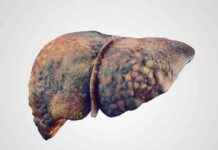 Minimal Hepatic Encephalopathy Biomarker Evaluation in Cirrhotic Patients minimal-hepatic-encephalopathy-biomarker-evaluation-in-cirrhotic-patients