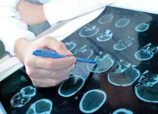 Potansiyel Epilepsi Tanısı için Biyobelirteçler Açığa Çıkarıldı potansiyel-epilepsi-tans-iin-biyobelirteler-aa-karld