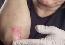 Psoriasis Hastalarında Bağırsak İltihabı ve Sindirim Sorunları psoriasis-hastalarnda-barsak-iltihab-ve-sindirim-sorunlar