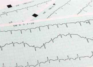 Diseased Hearts: Arrhythmia Study Supported by NSF Grant diseased-hearts-arrhythmia-study-supported-by-nsf-grant