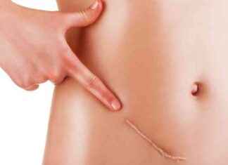 Doğum kontrol hapı yumurtalık kanseri riskini azaltabilir doum-kontrol-hap-yumurtalk-kanseri-riskini-azaltabilir