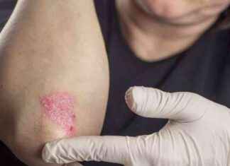 Mavi Işık Aktivasyonu ile Psoriazis Tedavisi için Yeni Bileşik mavi-k-aktivasyonu-ile-psoriazis-tedavisi-iin-yeni-bileik