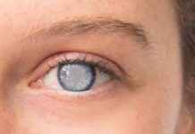 NR2F1, Katarakt Oluşumunu Aktive Ederek STAT3 Yolunu Teşvik Ediyor nr2f1-katarakt-oluumunu-aktive-ederek-stat3-yolunu-tevik-ediyor